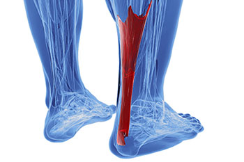 Achilles tendon treatment in the Kanawha County, WV: Charleston (South Charleston, St Albans, Nitro, Pinch, Sissonville, Alum Creek, Quincy, Belle, Elkview) areas