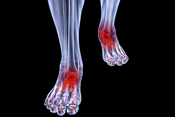 Arthritic foot care in the Kanawha County, WV: Charleston (South Charleston, St Albans, Nitro, Pinch, Sissonville, Alum Creek, Quincy, Belle, Elkview) areas