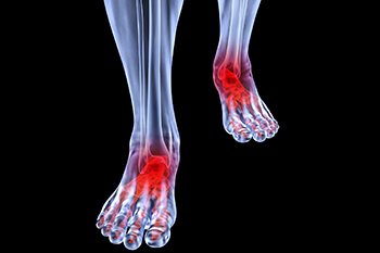 Arthritic foot care in the Kanawha County, WV: Charleston (South Charleston, St Albans, Nitro, Pinch, Sissonville, Alum Creek, Quincy, Belle, Elkview) areas