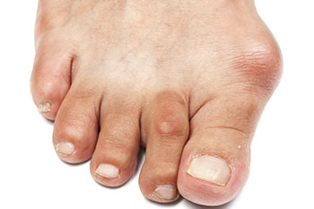 Bunions treatment and removal in the Kanawha County, WV: Charleston (South Charleston, St Albans, Nitro, Pinch, Sissonville, Alum Creek, Quincy, Belle, Elkview) areas