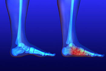 Flat feet treatment in the Kanawha County, WV: Charleston (South Charleston, St Albans, Nitro, Pinch, Sissonville, Alum Creek, Quincy, Belle, Elkview) areas