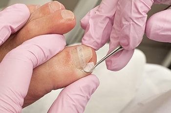 Ingrown toenail treatment in the Kanawha County, WV: Charleston (South Charleston, St Albans, Nitro, Pinch, Sissonville, Alum Creek, Quincy, Belle, Elkview) areas