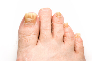 Toenail fungus treatment in the Kanawha County, WV: Charleston (South Charleston, St Albans, Nitro, Pinch, Sissonville, Alum Creek, Quincy, Belle, Elkview) areas