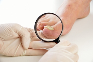 Managing Toenail Fungus Infections