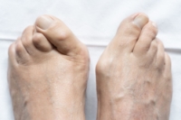 Managing Bunions