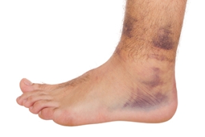 The Importance of Diagnosing an Ankle Sprain